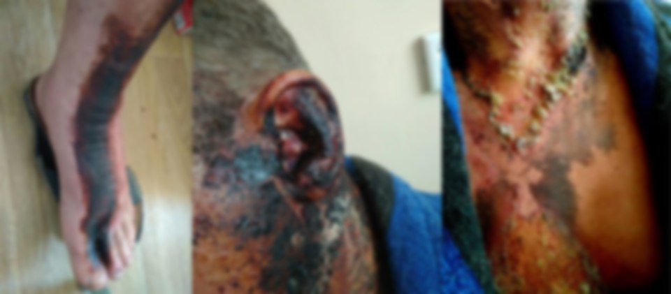 «Перепонка сгорела, а ноги стали черными»: как живет сибиряк, которого при ударе молнией спас нательный крестик «Перепонка сгорела, а ноги стали черными»: как живет сибиряк, которого при ударе молнией спас нательный крестик