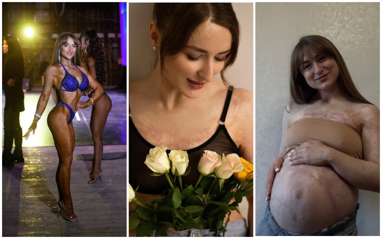 «Платье снимали вместе с кожей»: как сложилась судьба девочки, которая получила ожог 74% тела из-за кастрюли супа