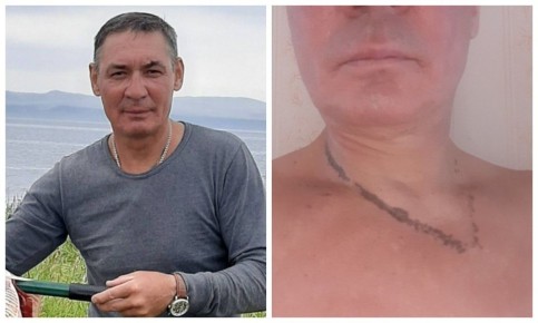 «Перепонка сгорела, а ноги стали черными»: как живет сибиряк, которого при ударе молнией спас нательный крестик