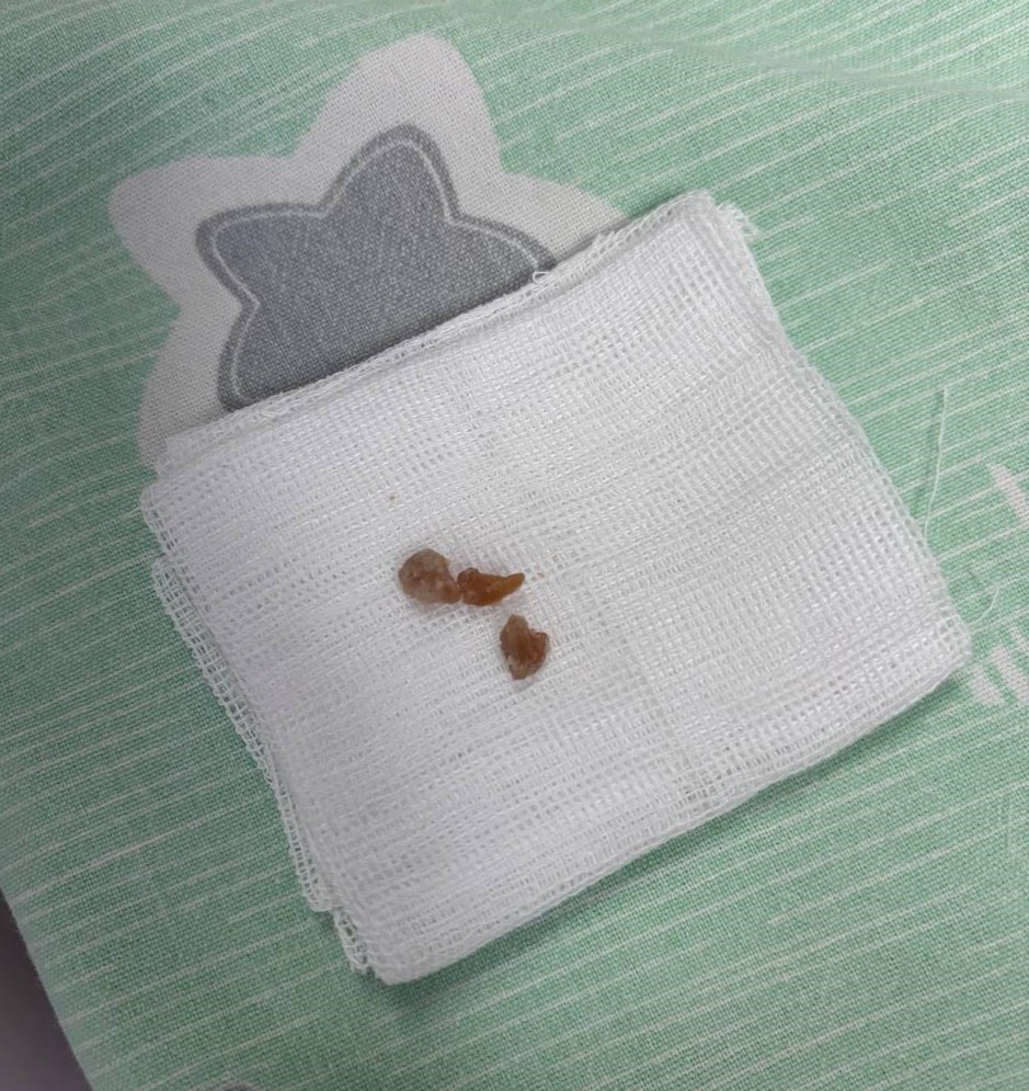 Ребенок попал на операционный стол из-за кусочка арахиса