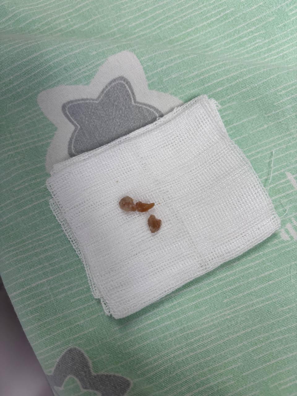 «Случайно сделал вдох во время игры»: годовалый малыш едва не погиб от кусочка арахиса