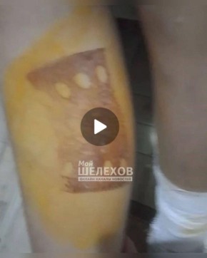 Жесть из Иркутской области: школьники-садисты прижгли ногу утюгом 13-летней девочке и избили ее шнуром по лицу