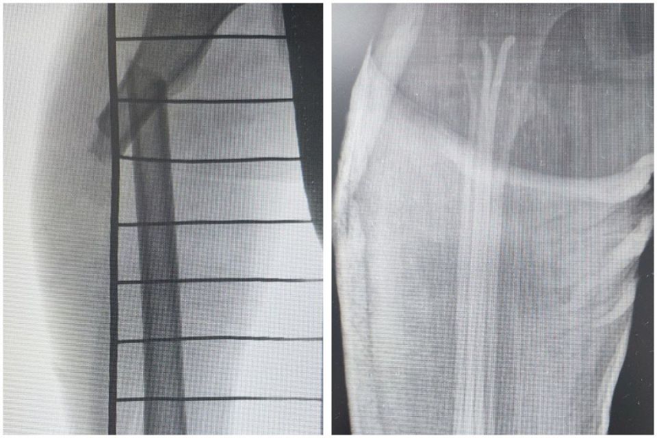 В Бурятии 7-летний мальчик сломал бедро, катаясь на тюбинге