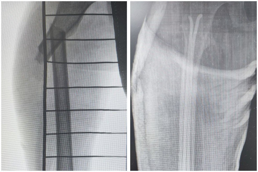 В Бурятии 7-летний мальчик сломал бедро, катаясь на тюбинге