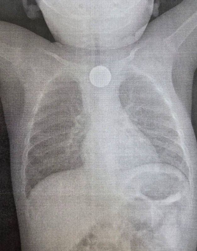 В Улан-Удэ медики спасли жизнь ребенку