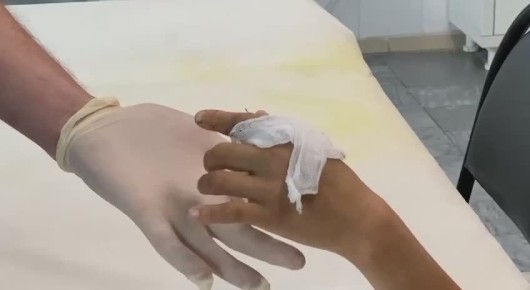 Иркутские хирурги пришили школьнику отрубленный палец