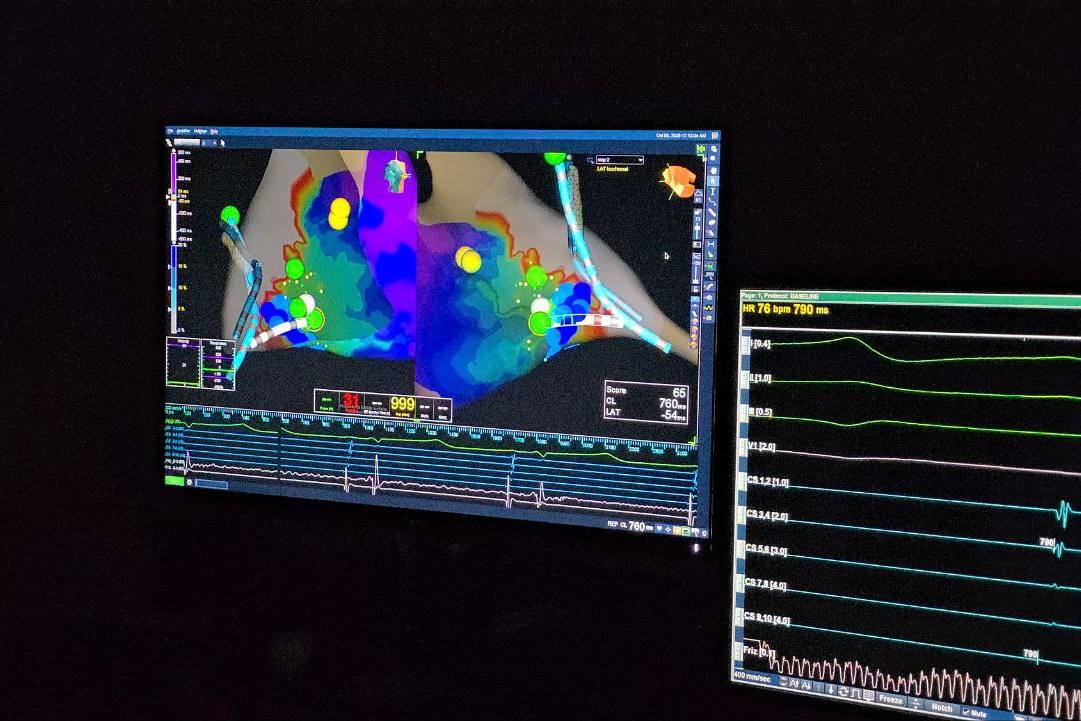 В Иркутской областной больнице впервые применили внутрисердечное УЗИ при операциях по поводу нарушений ритма сердца В Иркутской областной больнице впервые применили внутрисердечное УЗИ при операциях по поводу нарушений ритма сердца