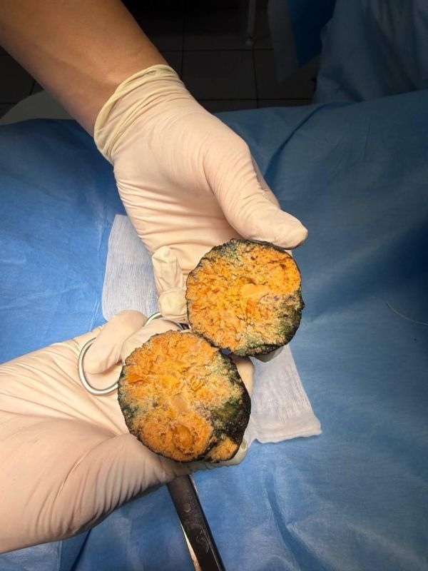 «Съел хурму и запил молоком»: боль в животе после перекуса обернулась для сибиряка операцией