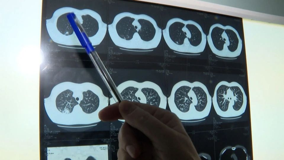 Заболеваемость туберкулезом в Иркутской области идет на спад