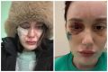 Девушка обвинила мужа в измене, а тот превратил её жизнь в ад: «Один глаз навсегда ослеп, а второй - под угрозой»