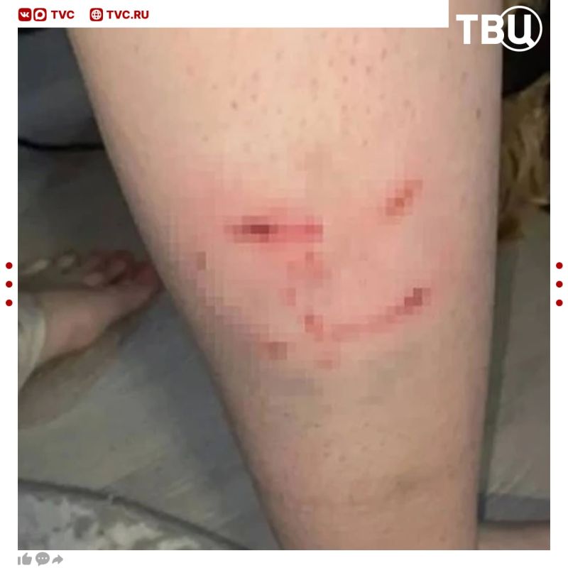 Бродячая собака прокусила ногу 15-летней школьнице в Иркутской области
