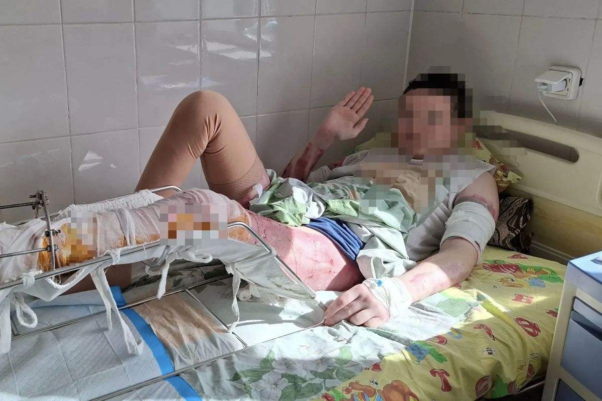 «Тело превратилось в одну сплошную рану…»: хирурги спасли подростку ноги после жуткой аварии, невзирая на все прогнозы